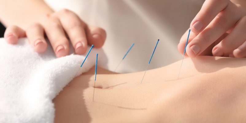 Acupuntura